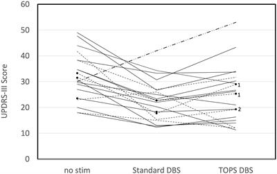 Temporally optimized patterned stimulation (TOPS®) as a therapy to personalize deep brain stimulation treatment of Parkinson’s disease